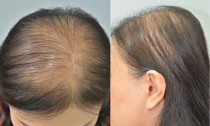 Women Fighting Hair Loss: Understanding, Treating, and Overcoming Female Baldness