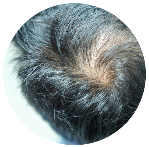 AMP-303, a promising new treatment for male pattern baldness
